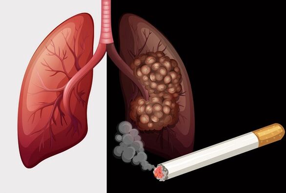 sigara içenlerin akciğerleri ve sağlıklı akciğerleri